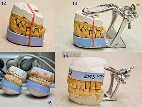 Как делают зубы